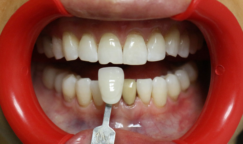 Professional Teeth Whitening Before and After