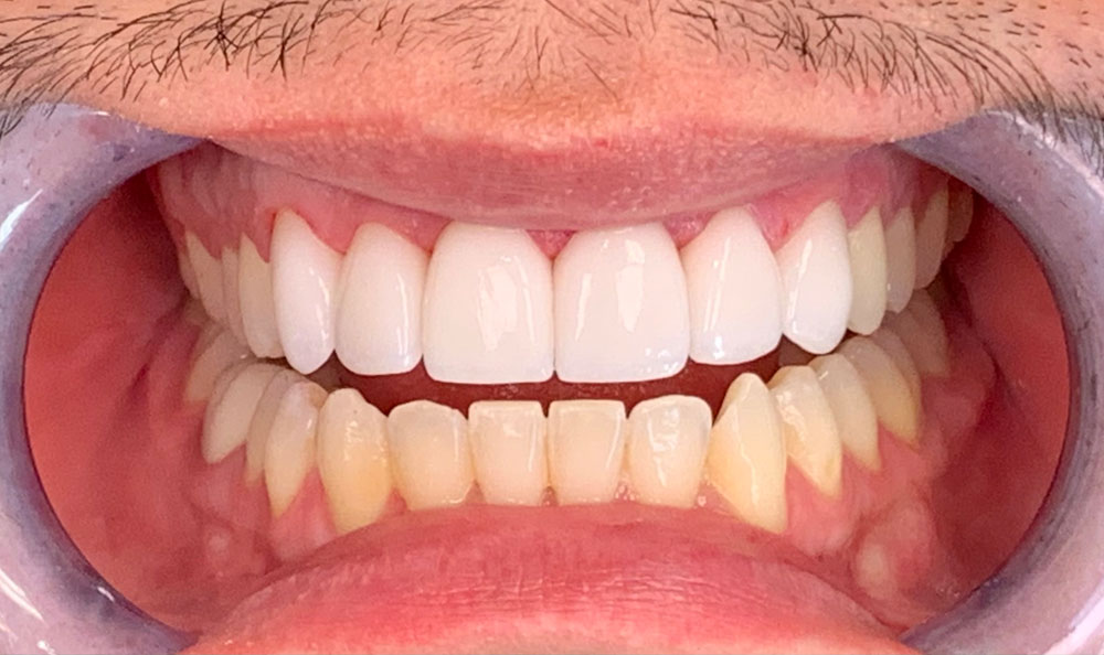 Teeth Whitening After