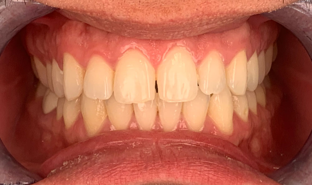 Affordable Dental Veneers Near Me Dental Veneers Cost Houston